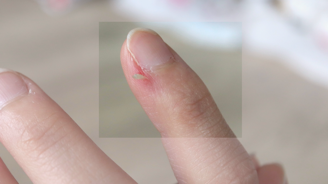 Hangnails: What Causes Them and How to Prevent Them